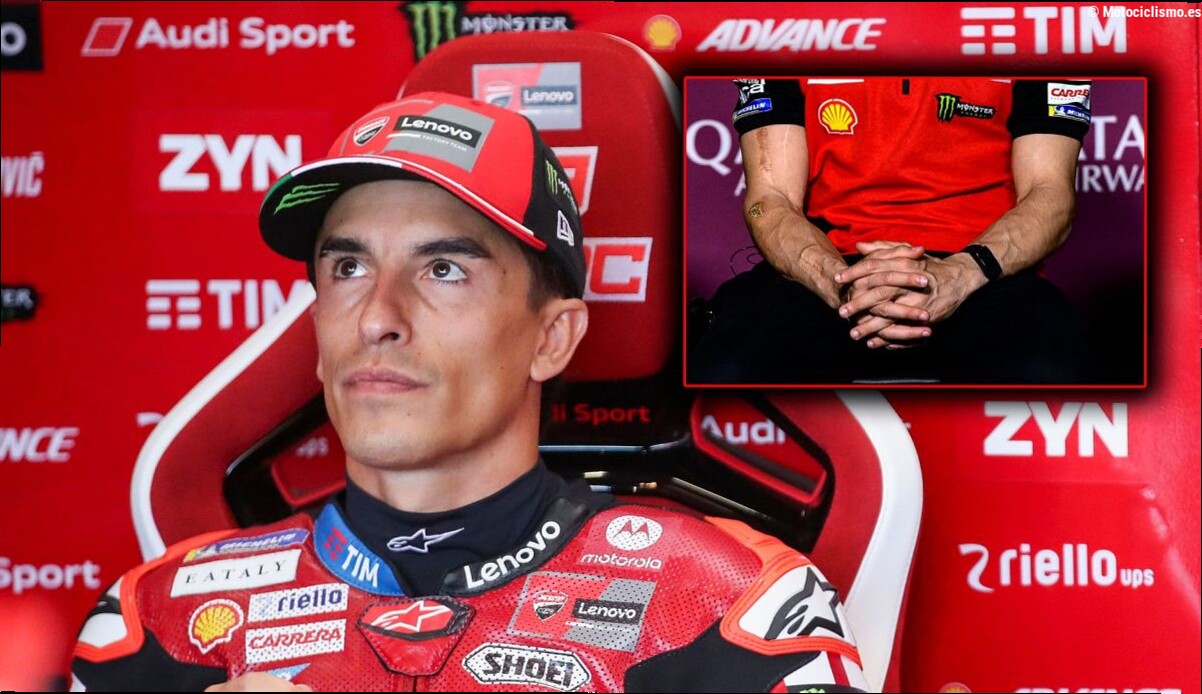 El médico que operó a Marc Márquez explica el estado real de su brazo: "Corre con un brazo y medio"