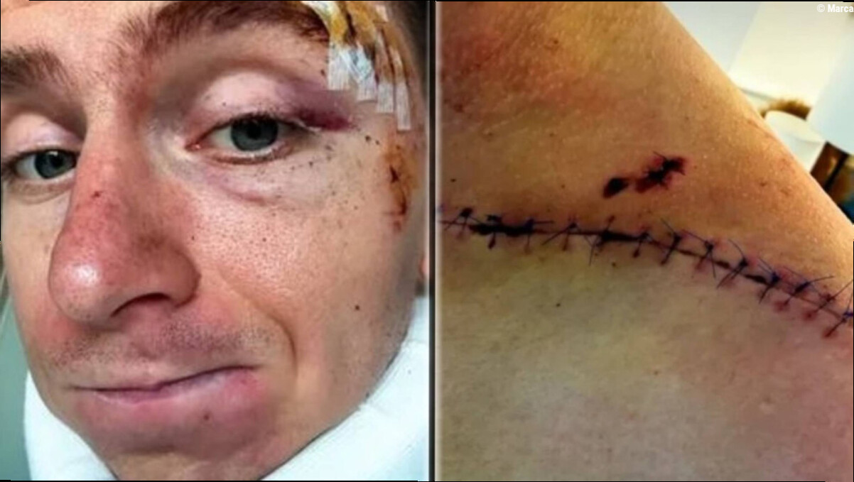 Pogacar desnuda sus cicatrices para sus millones de seguidores tras su brutal caída